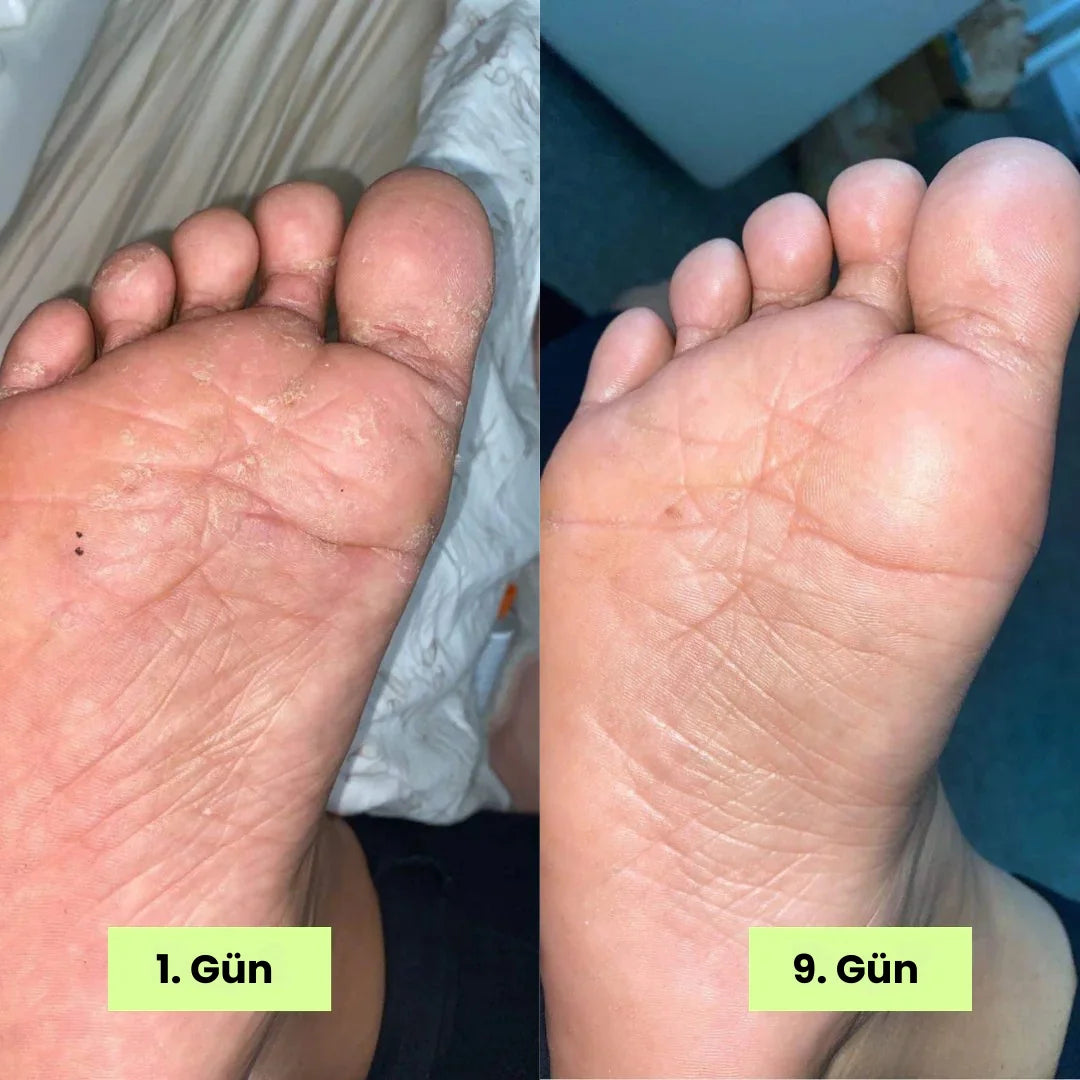 Loravey® Mantar Karşıtı Rahatlatıcı Sabun Bar